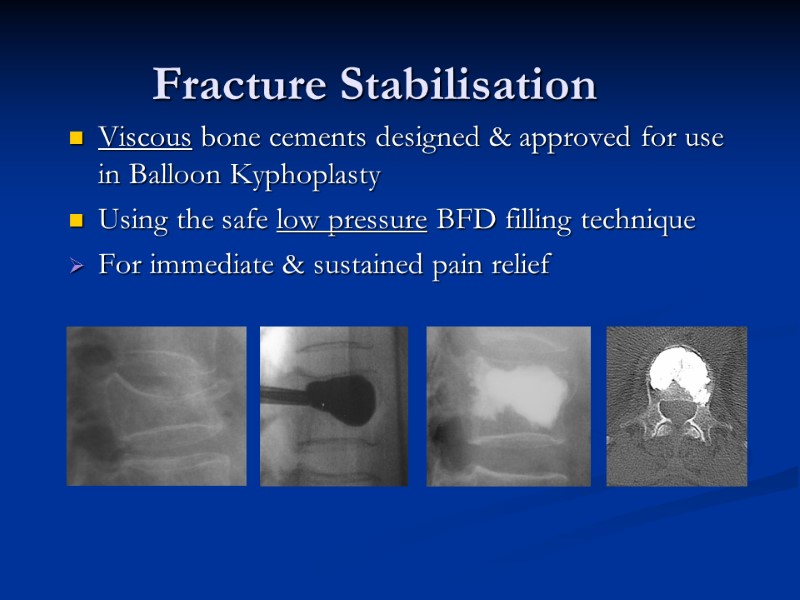 Fracture Stabilisation Viscous bone cements designed & approved for use in Balloon Kyphoplasty 